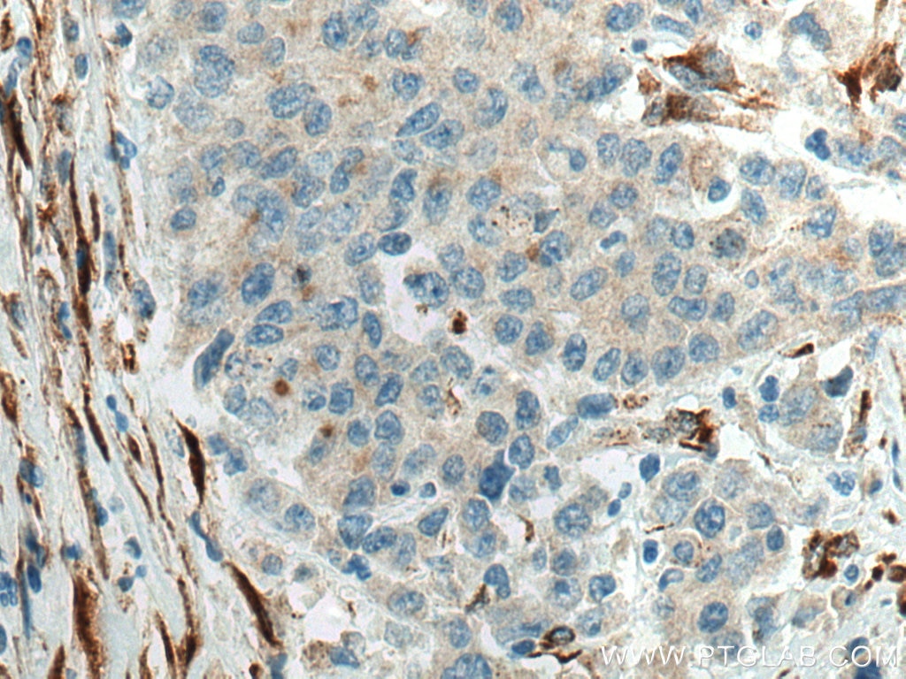 Immunohistochemistry (IHC) staining of human stomach cancer tissue using SPARC Polyclonal antibody (15274-1-AP)