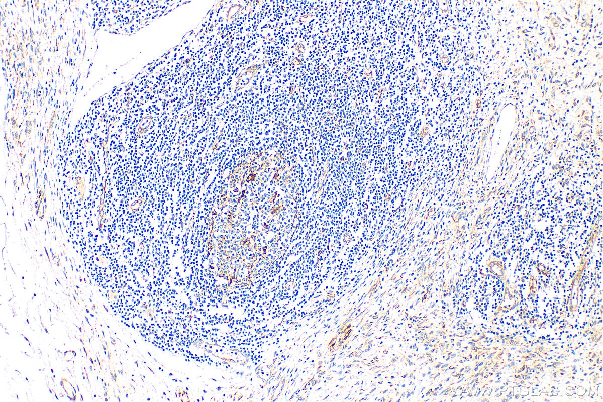Immunohistochemistry (IHC) staining of human stomach cancer tissue using SPARC Polyclonal antibody (15274-1-AP)