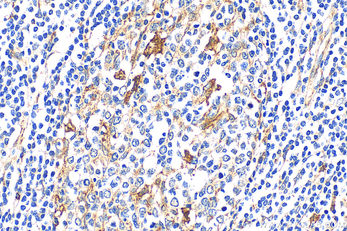 Immunohistochemistry (IHC) staining of human stomach cancer tissue using SPARC Polyclonal antibody (15274-1-AP)