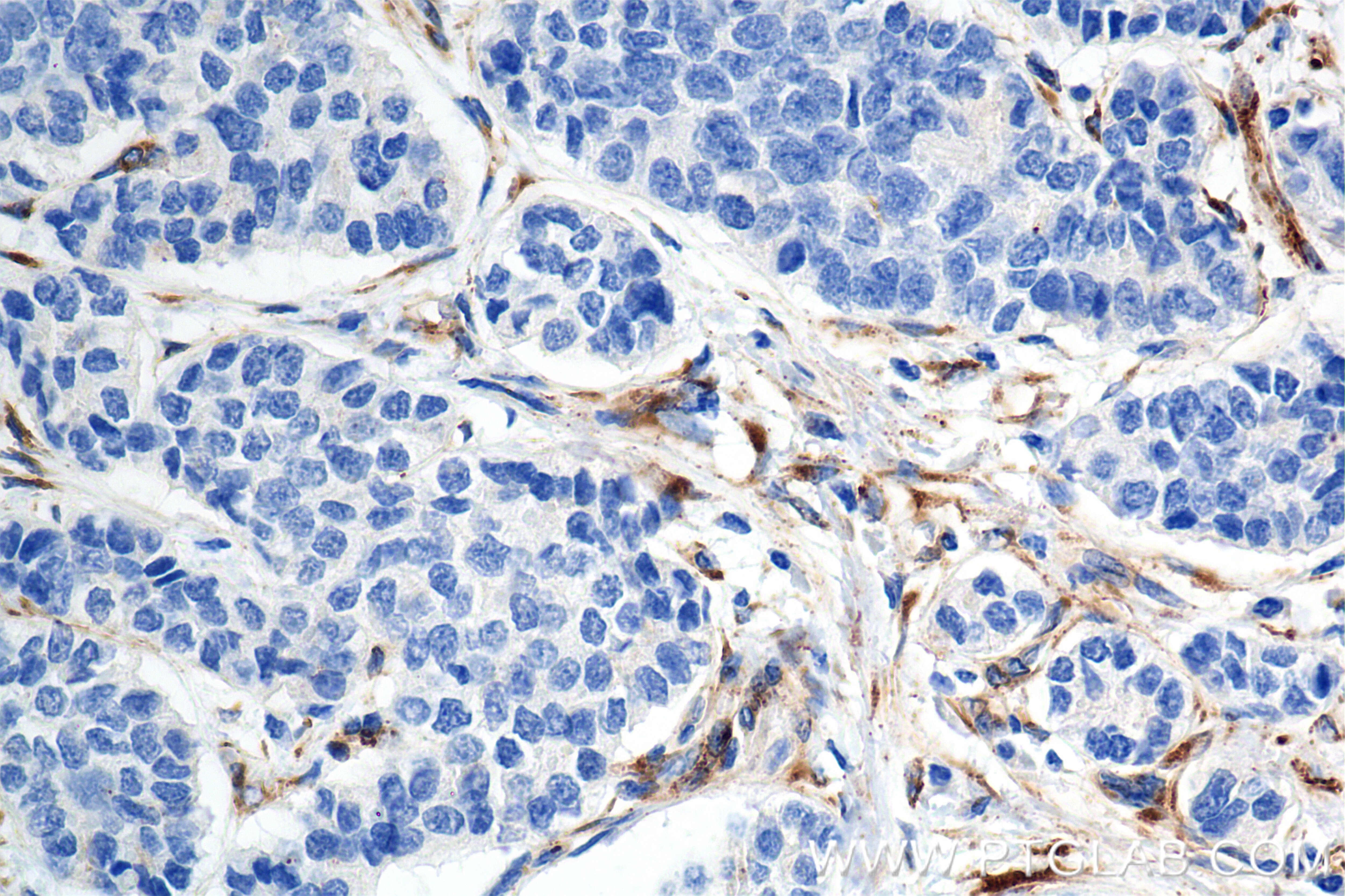 Immunohistochemistry (IHC) staining of human stomach cancer tissue using SPARC Recombinant antibody (84621-3-RR)