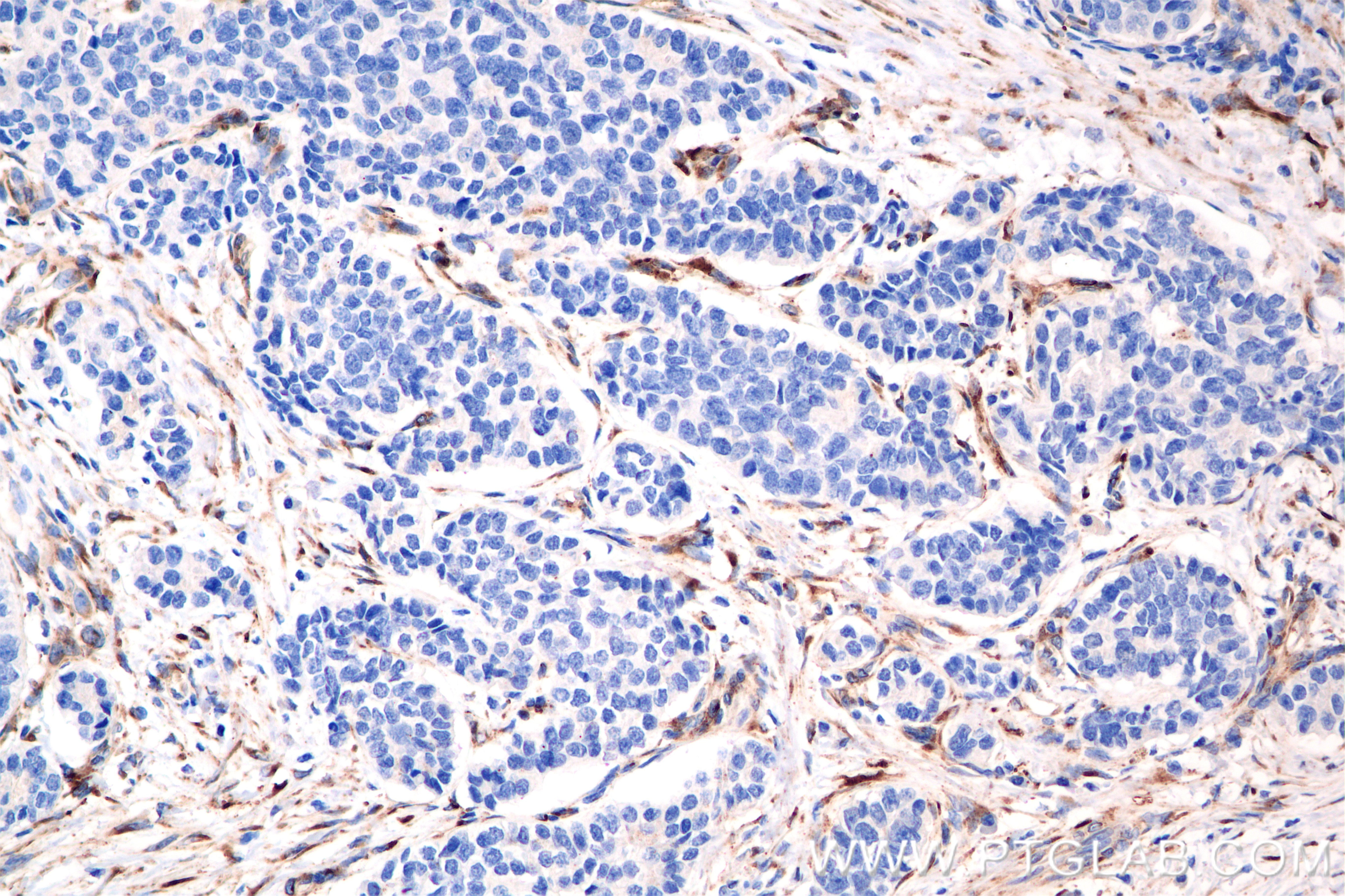 Immunohistochemistry (IHC) staining of human stomach cancer tissue using SPARC Recombinant antibody (84621-3-RR)