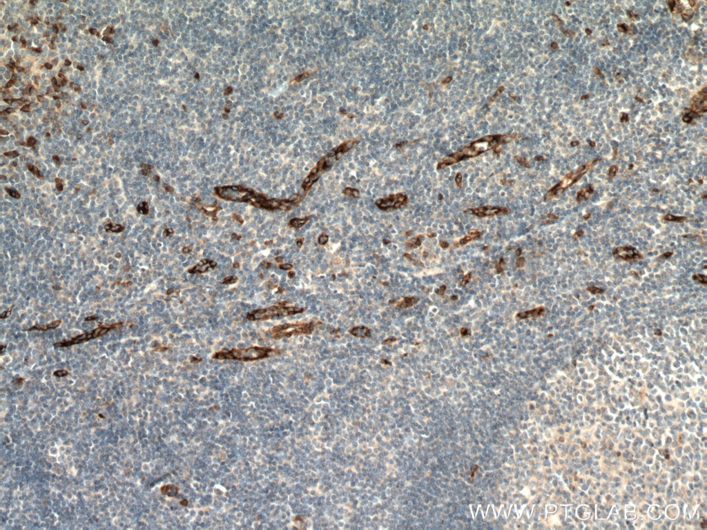 IHC staining of human tonsillitis using 13517-1-AP