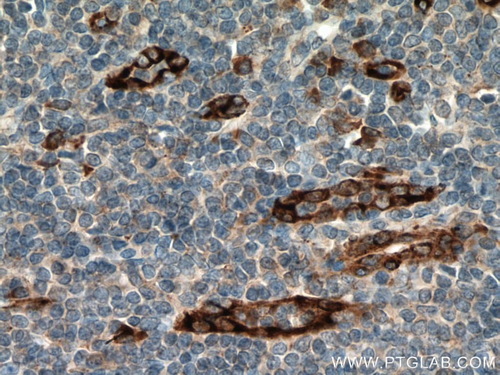 Immunohistochemistry (IHC) staining of human tonsillitis tissue using SPARCL1 Polyclonal antibody (13517-1-AP)