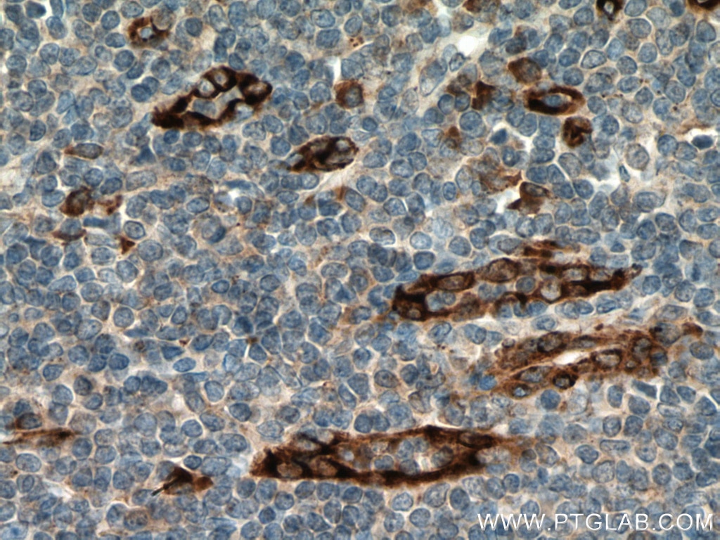 IHC staining of human tonsillitis using 13517-1-AP