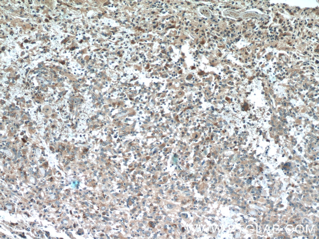 Immunohistochemistry (IHC) staining of human gliomas tissue using SPARCL1 Polyclonal antibody (13517-1-AP)