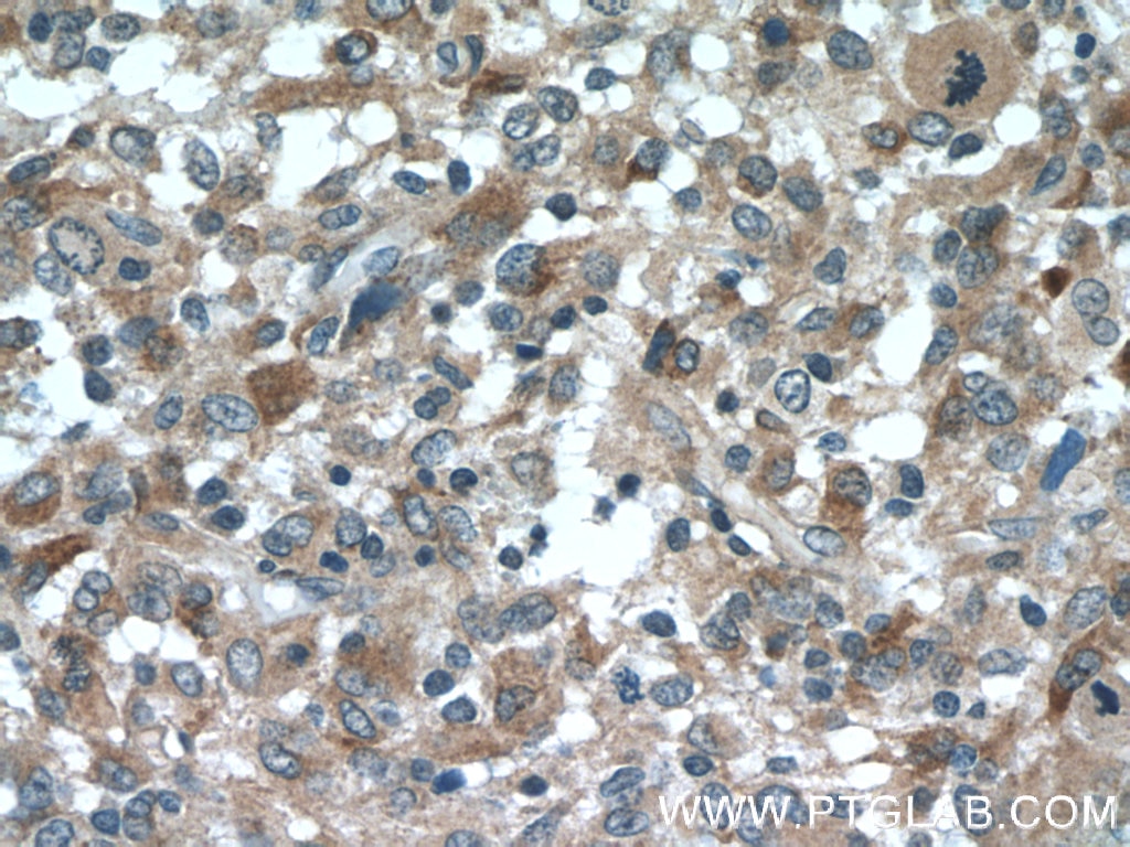 Immunohistochemistry (IHC) staining of human gliomas tissue using SPARCL1 Polyclonal antibody (13517-1-AP)