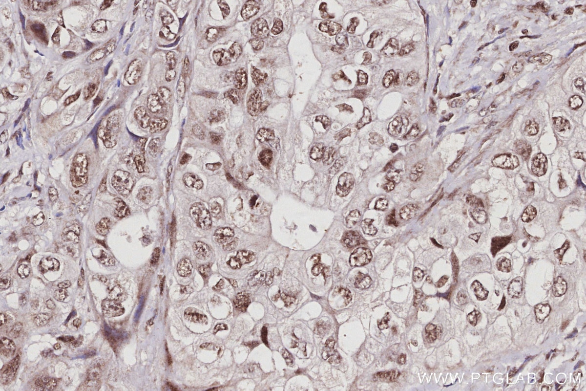 IHC staining of human pancreas cancer using 67361-1-Ig Immunohistochemistry (IHC) staining of human pancreas cancer tissue using SPAST Monoclonal antibody (67361-1-Ig)