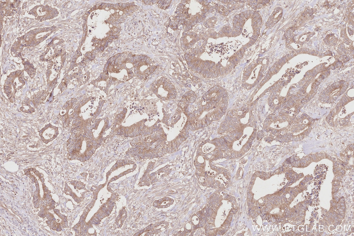Immunohistochemistry (IHC) staining of human rectal cancer tissue using SPATA13 Polyclonal antibody (21400-1-AP)