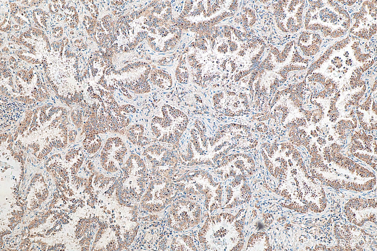 Immunohistochemistry (IHC) staining of human lung cancer tissue using SPATS2L Polyclonal antibody (29930-1-AP)