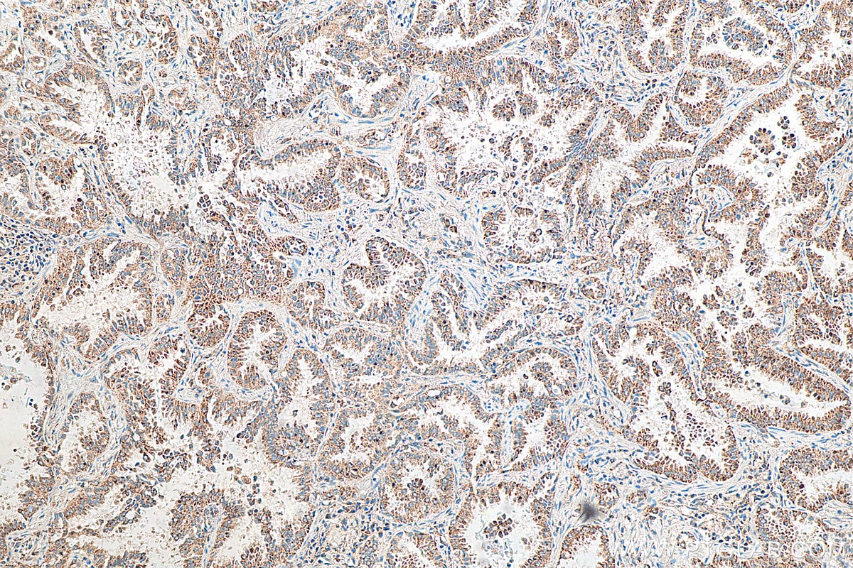 IHC staining of human lung cancer using 29930-1-AP