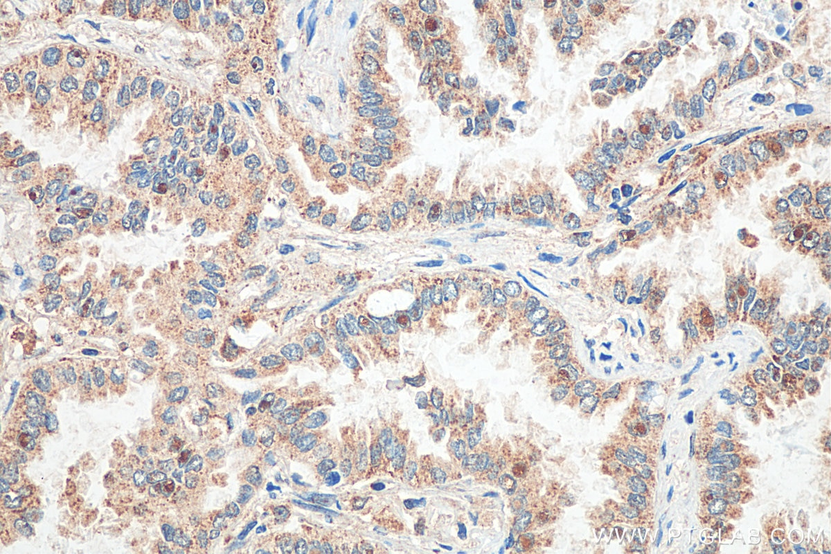 IHC staining of human lung cancer using 29930-1-AP