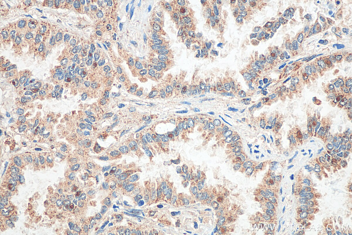 Immunohistochemistry (IHC) staining of human lung cancer tissue using SPATS2L Polyclonal antibody (29930-1-AP)