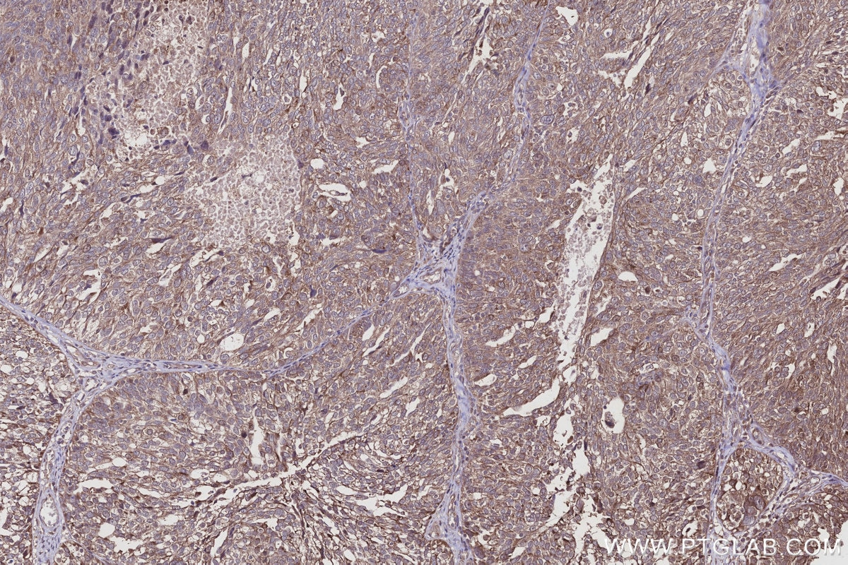Immunohistochemistry (IHC) staining of human ovary cancer tissue using SPC25 Polyclonal antibody (26474-1-AP)