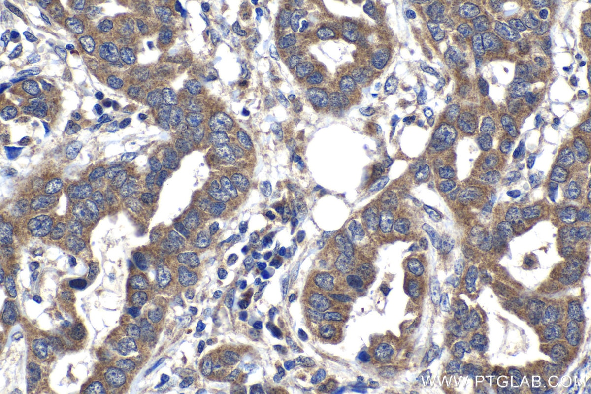 Immunohistochemistry (IHC) staining of human lung cancer tissue using SPDYC Polyclonal antibody (22471-1-AP)
