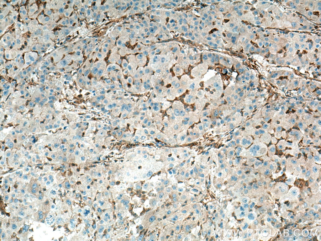 Immunohistochemistry (IHC) staining of human liver cancer tissue using Spartin, SPG20 Polyclonal antibody (13791-1-AP)