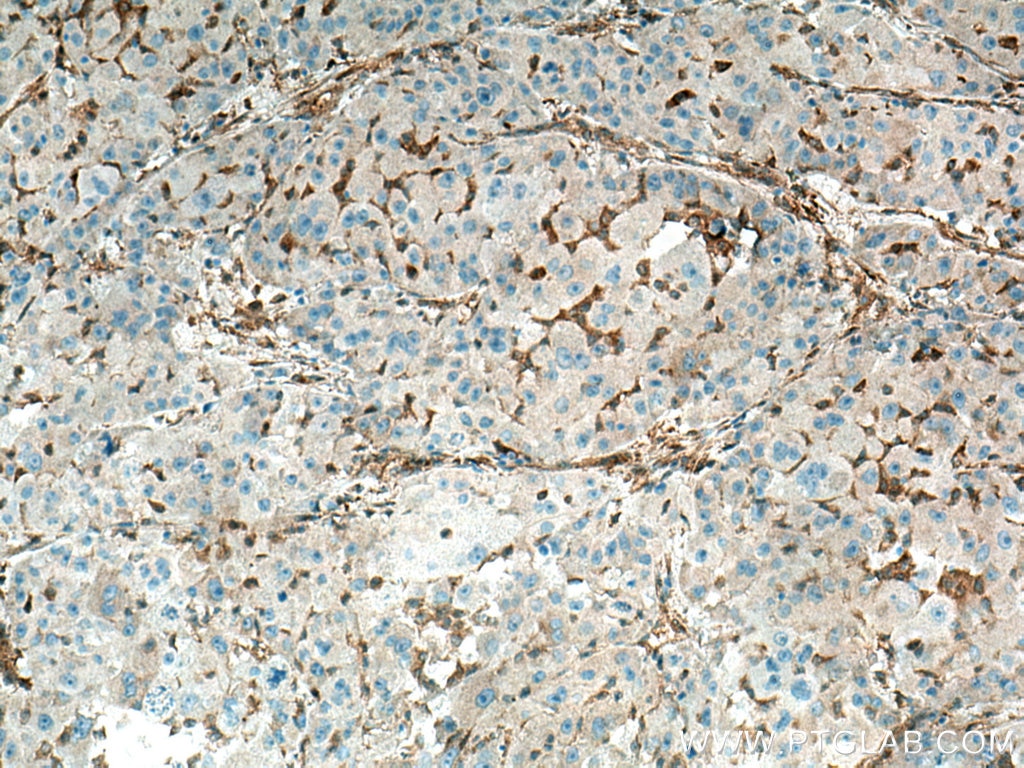 IHC staining of human liver cancer using 13791-1-AP