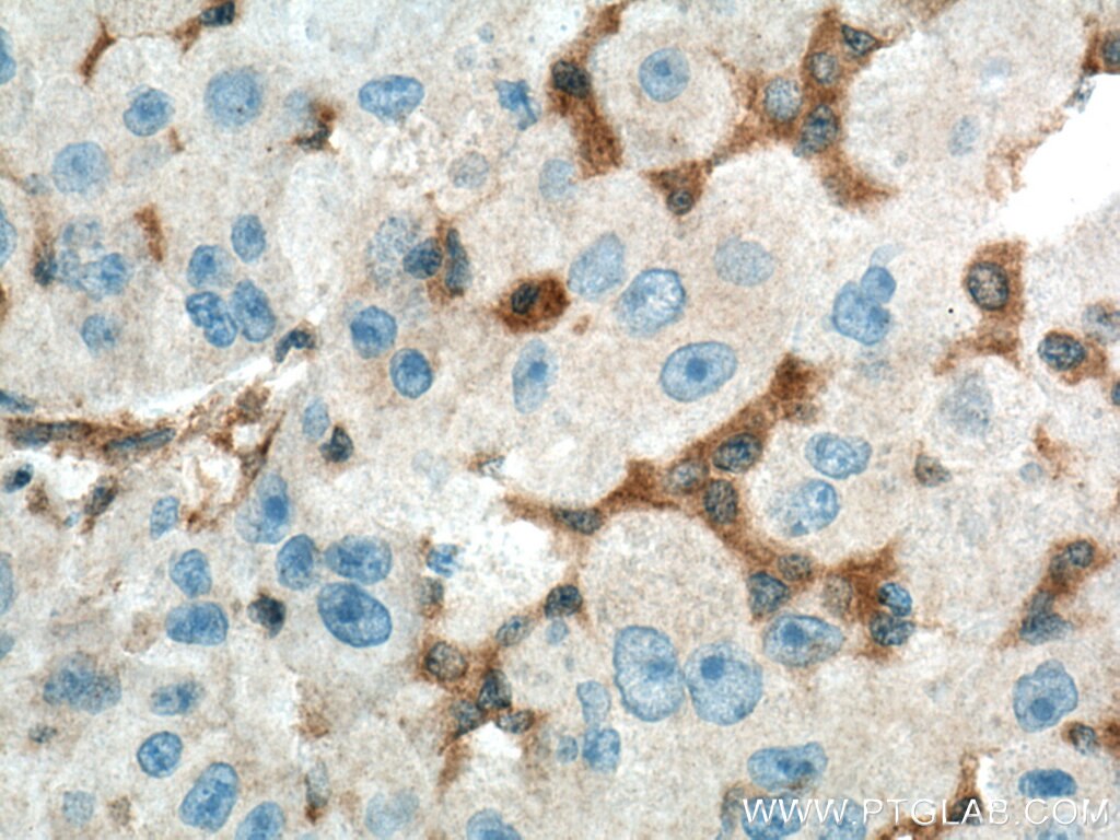 Immunohistochemistry (IHC) staining of human liver cancer tissue using Spartin, SPG20 Polyclonal antibody (13791-1-AP)