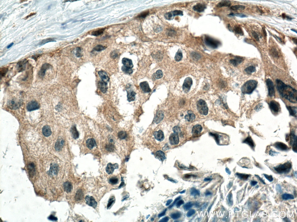 Immunohistochemistry (IHC) staining of human breast cancer tissue using Spartin, SPG20 Polyclonal antibody (13791-1-AP)