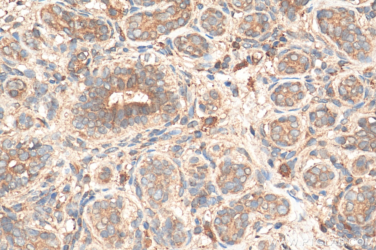 Immunohistochemistry (IHC) staining of human breast cancer tissue using SPHK1 Polyclonal antibody (10670-1-AP)