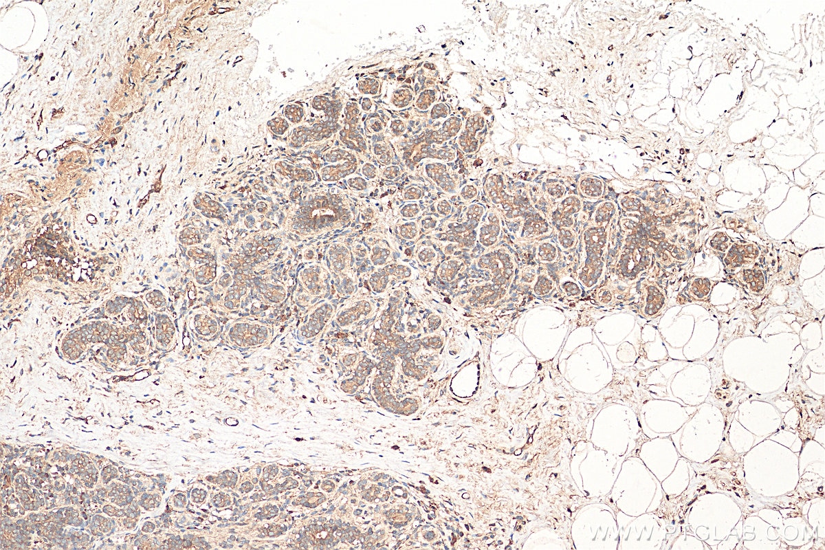 Immunohistochemistry (IHC) staining of human breast cancer tissue using SPHK1 Polyclonal antibody (10670-1-AP)