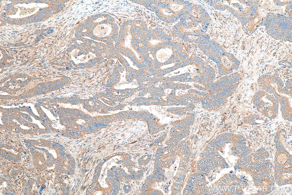IHC staining of human colon cancer using 10670-1-AP