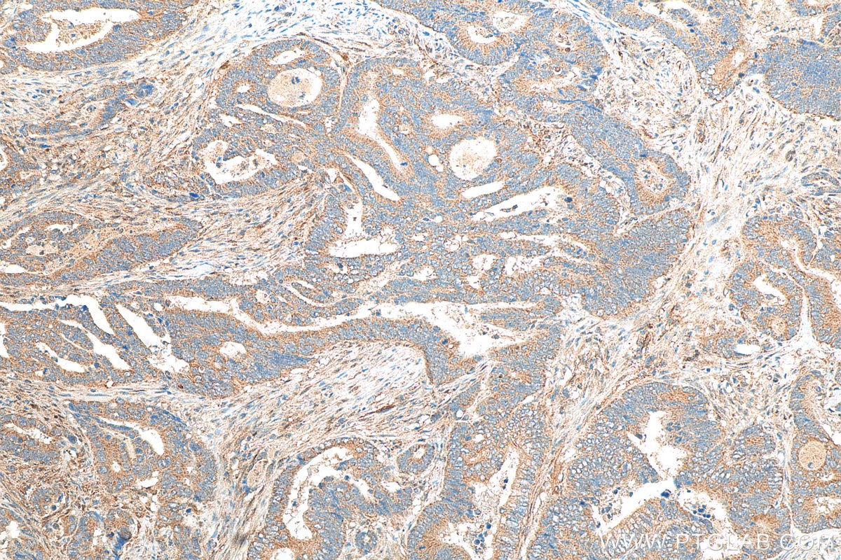 Immunohistochemistry (IHC) staining of human colon cancer tissue using SPHK1 Polyclonal antibody (10670-1-AP)