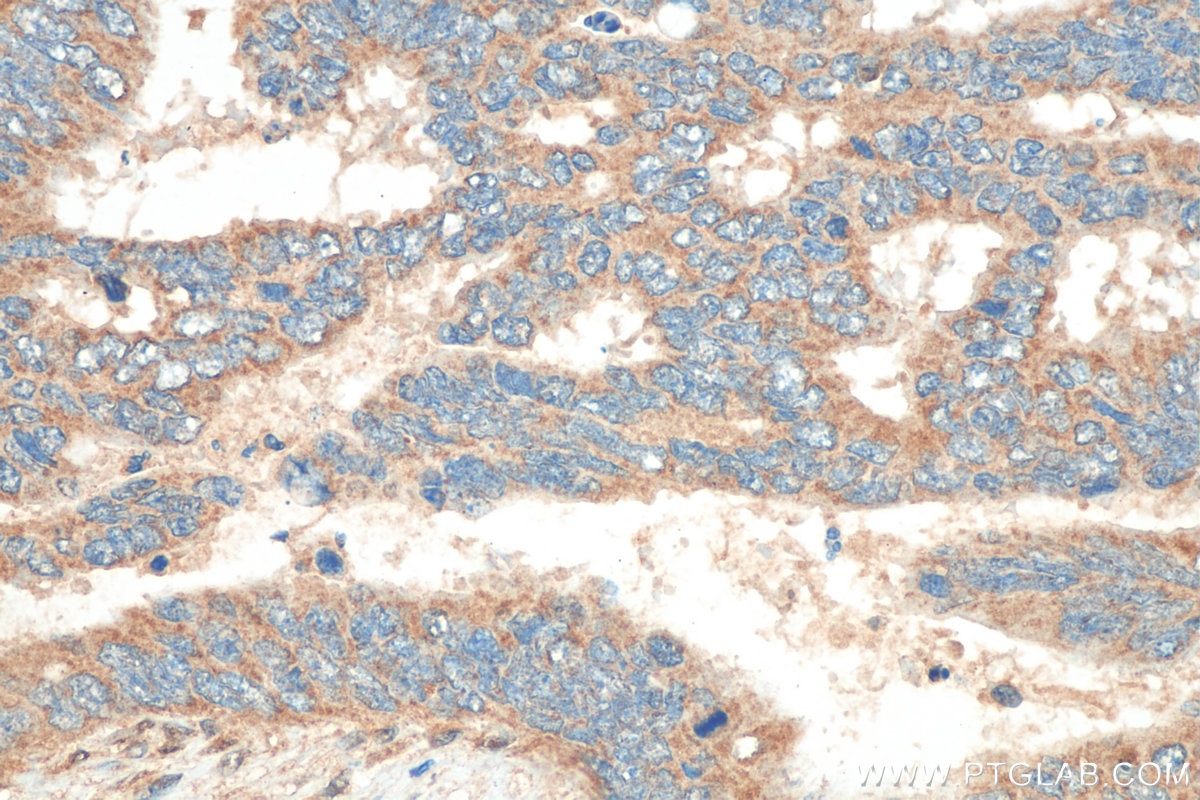 Immunohistochemistry (IHC) staining of human colon cancer tissue using SPHK1 Polyclonal antibody (10670-1-AP)