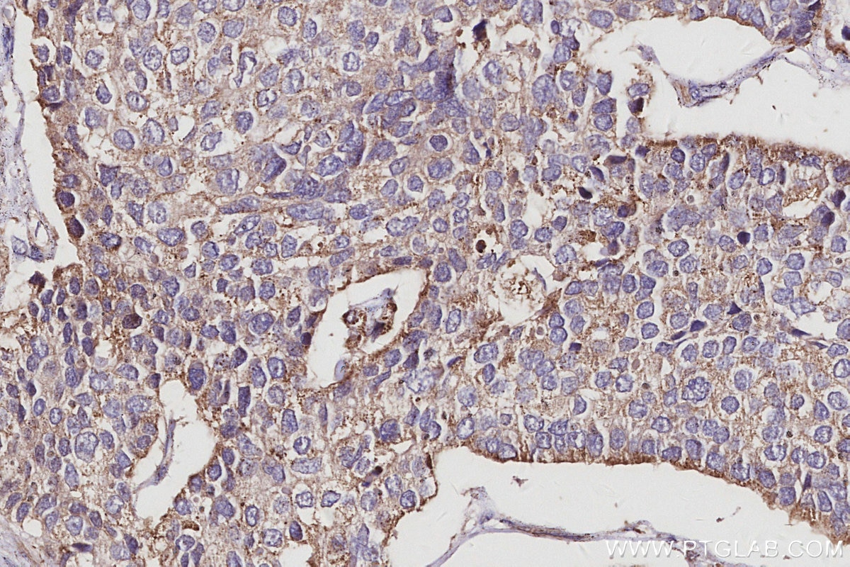 Immunohistochemistry (IHC) staining of human stomach cancer tissue using SPHK1 Polyclonal antibody (10670-1-AP)
