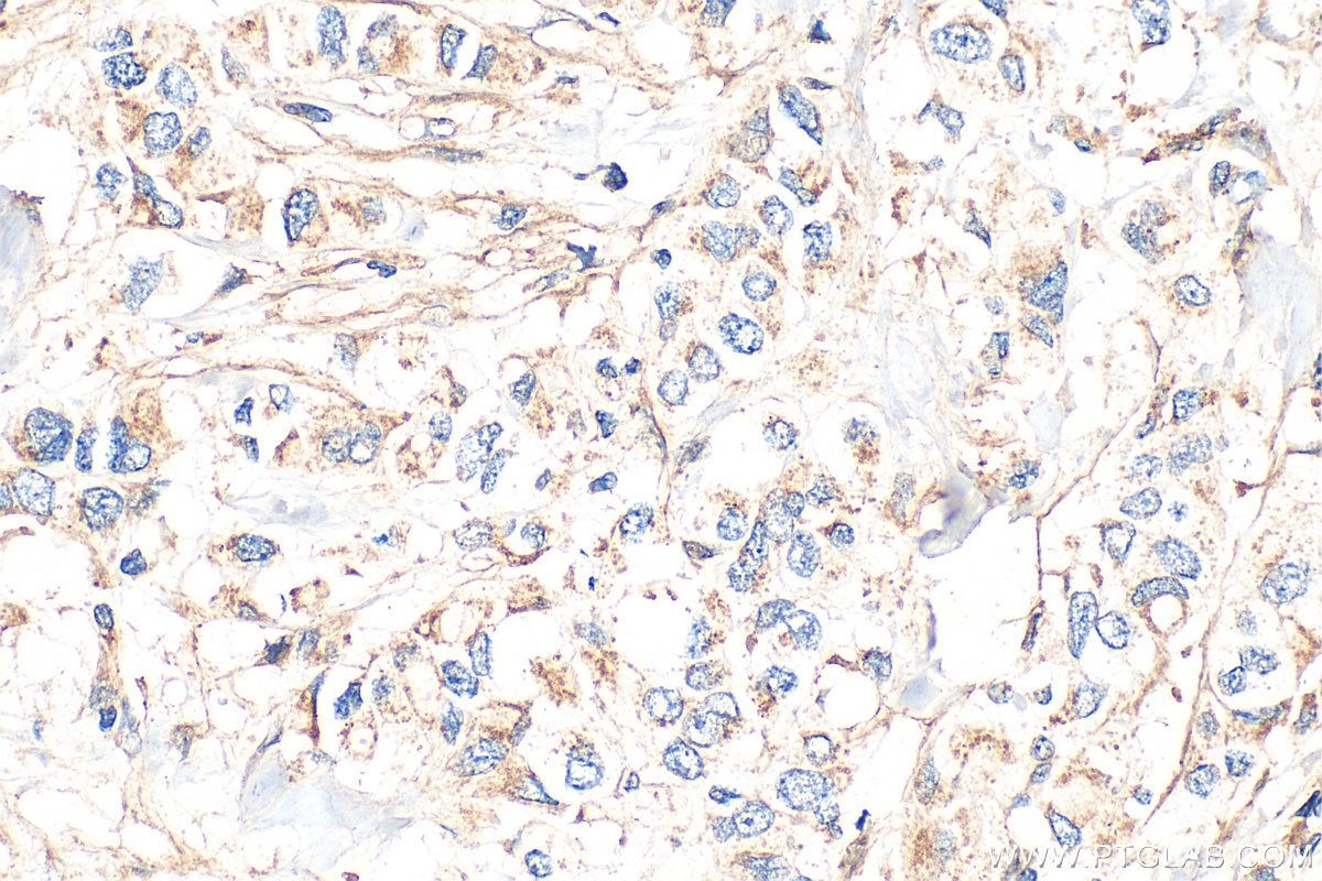 Immunohistochemistry (IHC) staining of human breast cancer tissue using SPHK1 Polyclonal antibody (10670-1-AP)