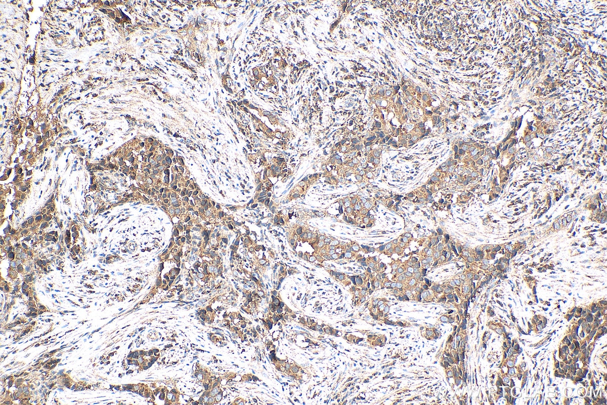 Immunohistochemistry (IHC) staining of human breast cancer tissue using SPHK2 Polyclonal antibody (17096-1-AP)