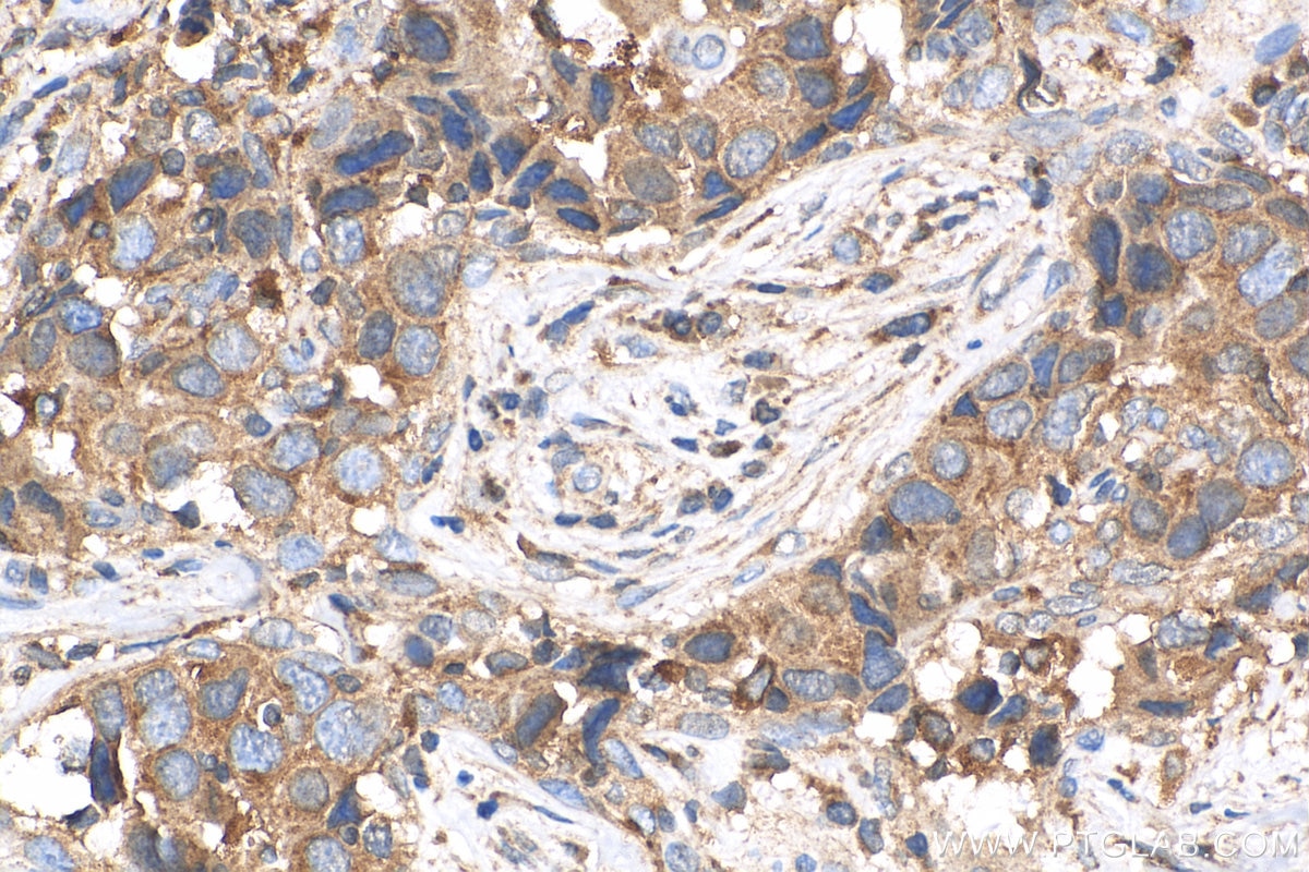 IHC staining of human breast cancer using 17096-1-AP