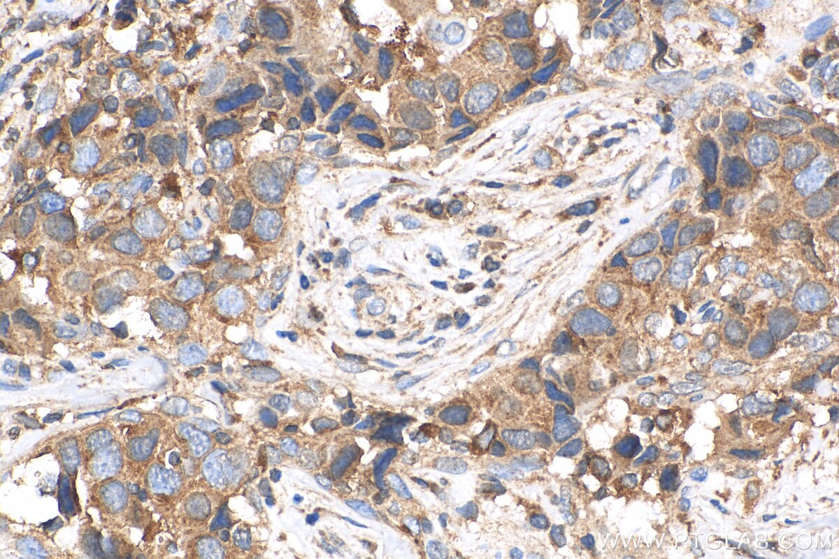 Immunohistochemistry (IHC) staining of human breast cancer tissue using SPHK2 Polyclonal antibody (17096-1-AP)