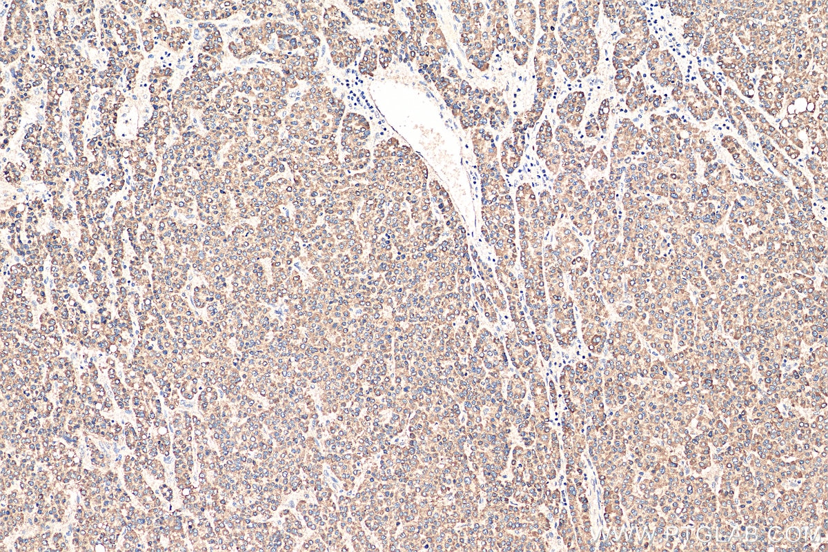 Immunohistochemistry (IHC) staining of human liver cancer tissue using SPIB Polyclonal antibody (15768-1-AP)