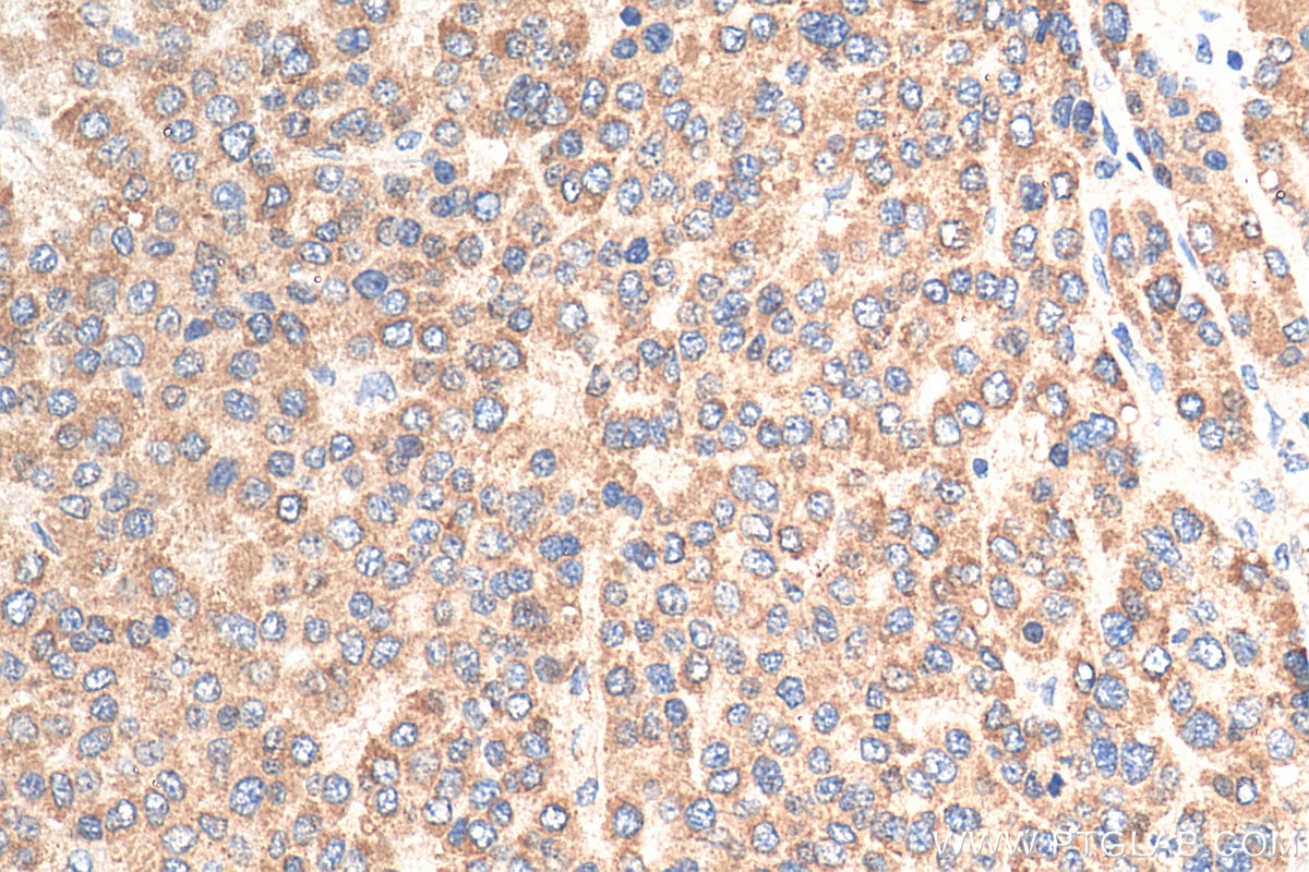 Immunohistochemistry (IHC) staining of human liver cancer tissue using SPIB Polyclonal antibody (15768-1-AP)