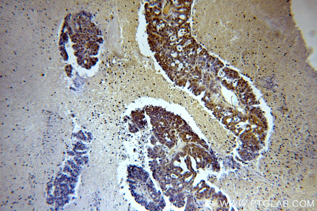 Immunohistochemistry (IHC) staining of human ovary tumor tissue using SPIN1-Specific Polyclonal antibody (19531-1-AP)