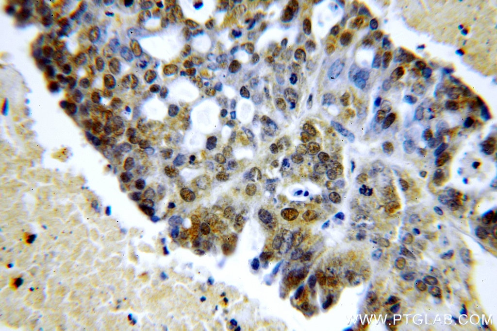 Immunohistochemistry (IHC) staining of human ovary tumor tissue using SPIN1-Specific Polyclonal antibody (19531-1-AP)