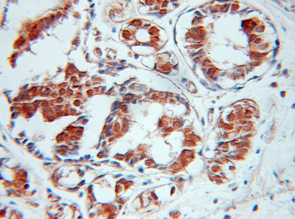 Immunohistochemistry (IHC) staining of human breast cancer tissue using SPIN2B Polyclonal antibody (10107-2-AP)