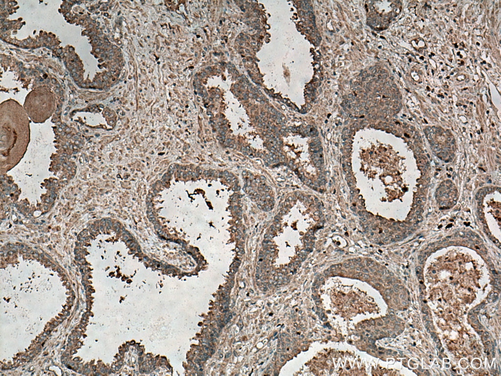 Immunohistochemistry (IHC) staining of human prostate cancer tissue using SPINK1 Polyclonal antibody (13477-1-AP)