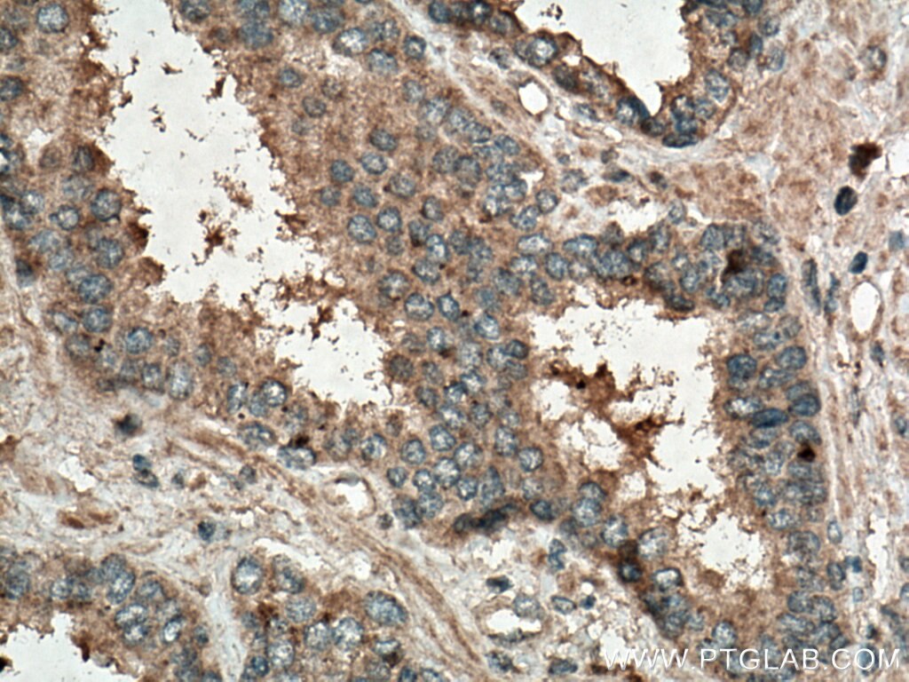 Immunohistochemistry (IHC) staining of human prostate cancer tissue using SPINK1 Polyclonal antibody (13477-1-AP)