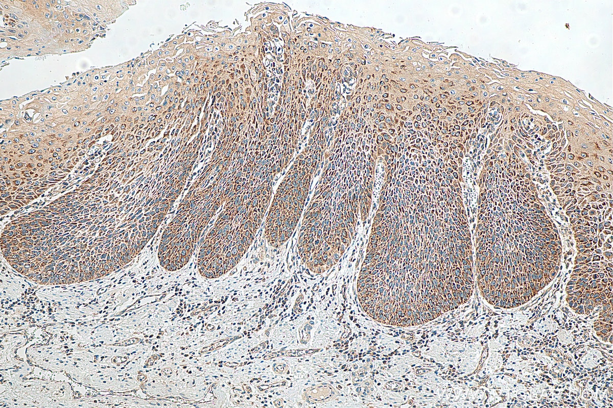 Immunohistochemistry (IHC) staining of human oesophagus cancer tissue using SPINK7 Polyclonal antibody (21155-1-AP)