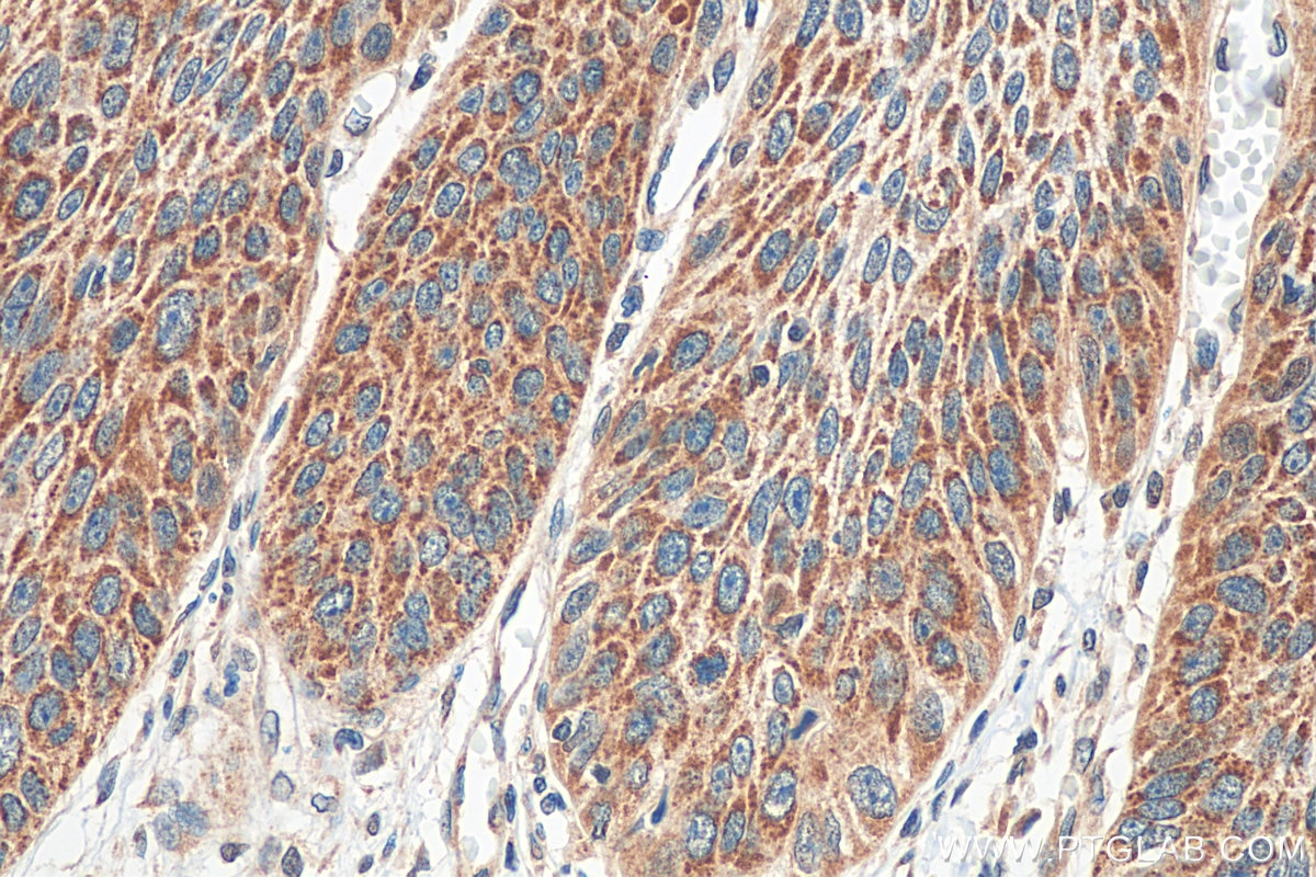 Immunohistochemistry (IHC) staining of human oesophagus cancer tissue using SPINK7 Polyclonal antibody (21155-1-AP)