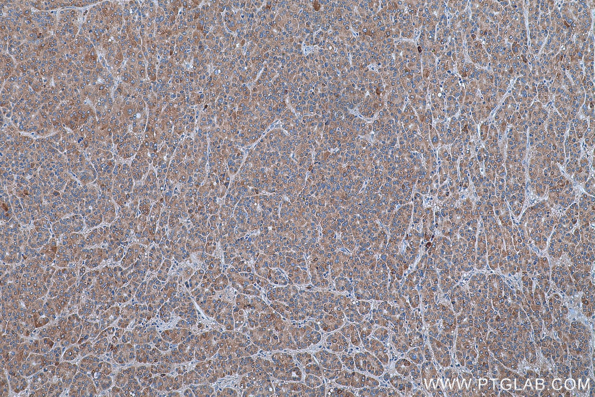 Immunohistochemistry (IHC) staining of human liver cancer tissue using SPINK9 Polyclonal antibody (24661-1-AP)