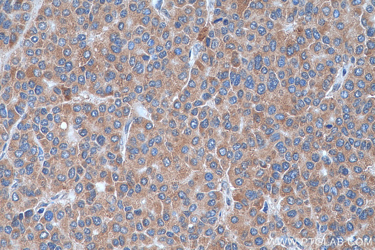 Immunohistochemistry (IHC) staining of human liver cancer tissue using SPINK9 Polyclonal antibody (24661-1-AP)