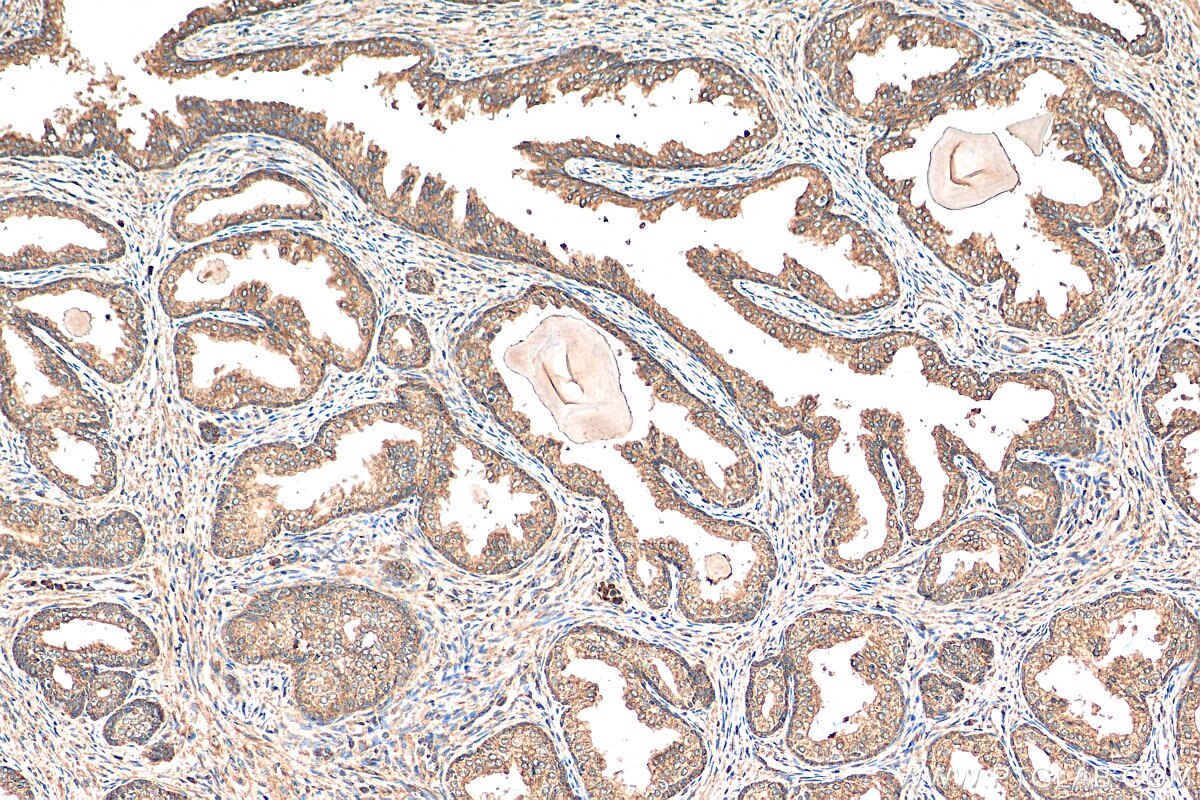 Immunohistochemistry (IHC) staining of human prostate cancer tissue using HAI-1 Polyclonal antibody (15036-1-AP)