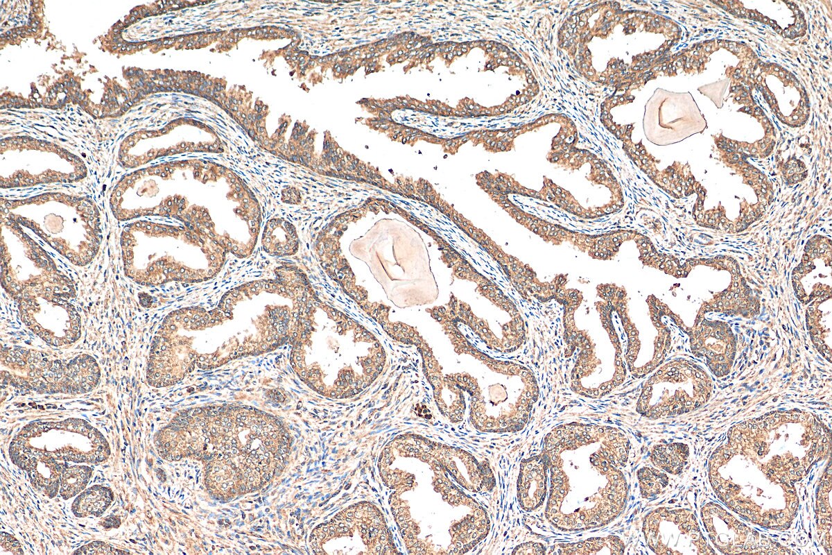 IHC staining of human prostate cancer using 15036-1-AP