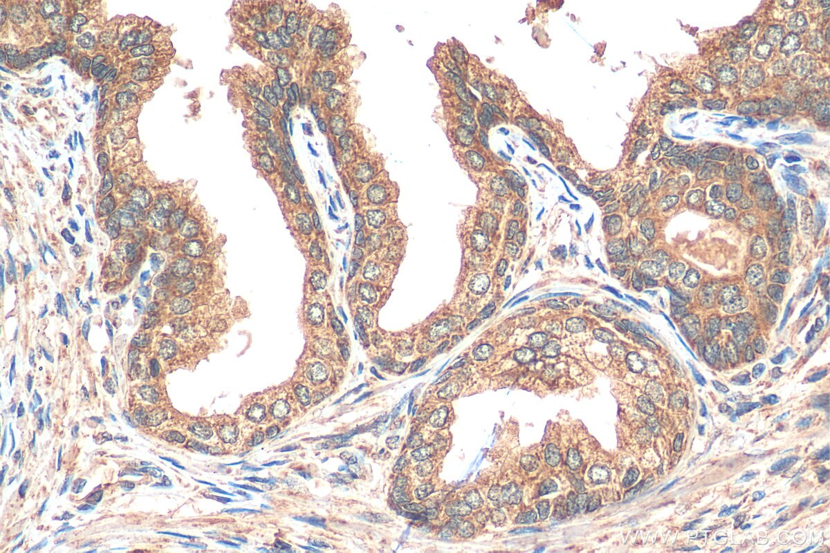 Immunohistochemistry (IHC) staining of human prostate cancer tissue using HAI-1 Polyclonal antibody (15036-1-AP)