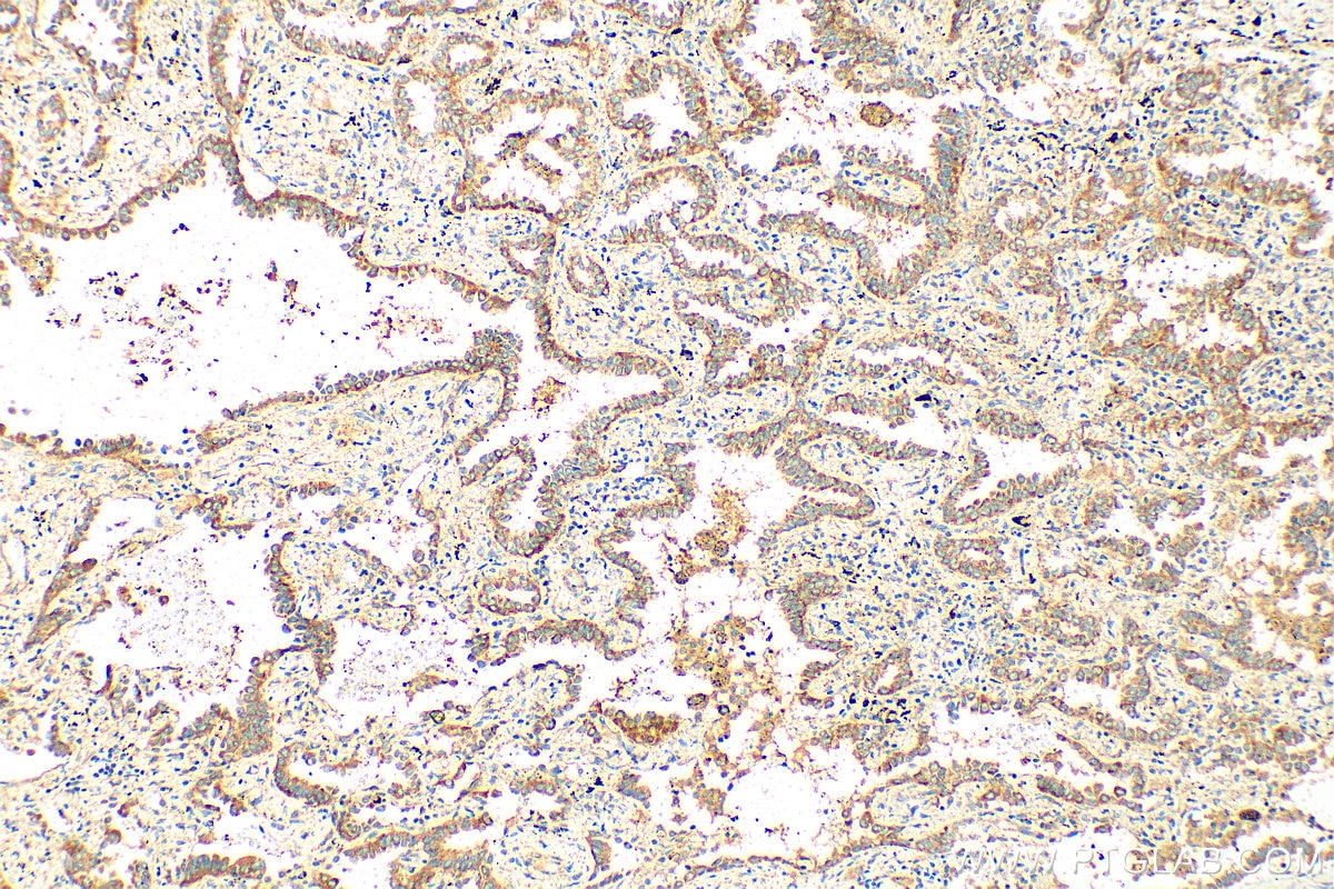 Immunohistochemistry (IHC) staining of human lung cancer tissue using SPIRE1 Polyclonal antibody (11295-1-AP)