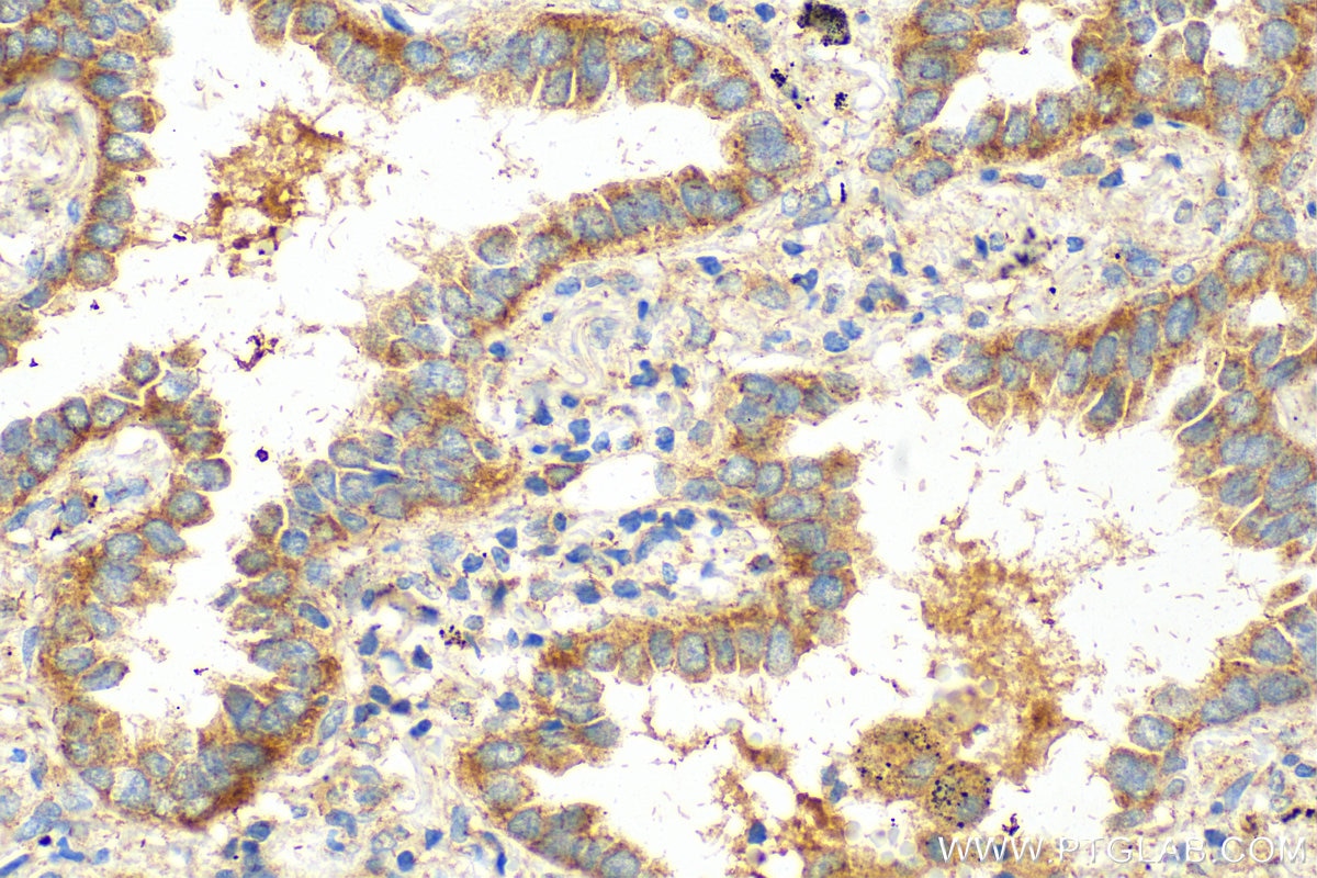 Immunohistochemistry (IHC) staining of human lung cancer tissue using SPIRE1 Polyclonal antibody (11295-1-AP)