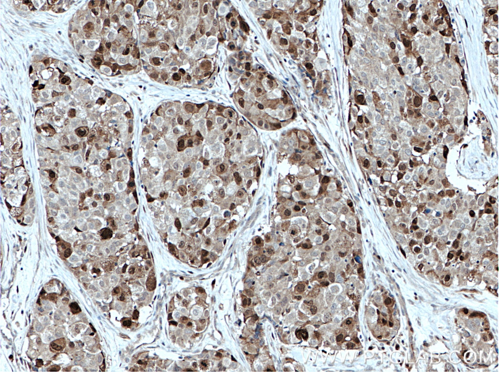 IHC staining of human lung cancer using 16110-1-AP