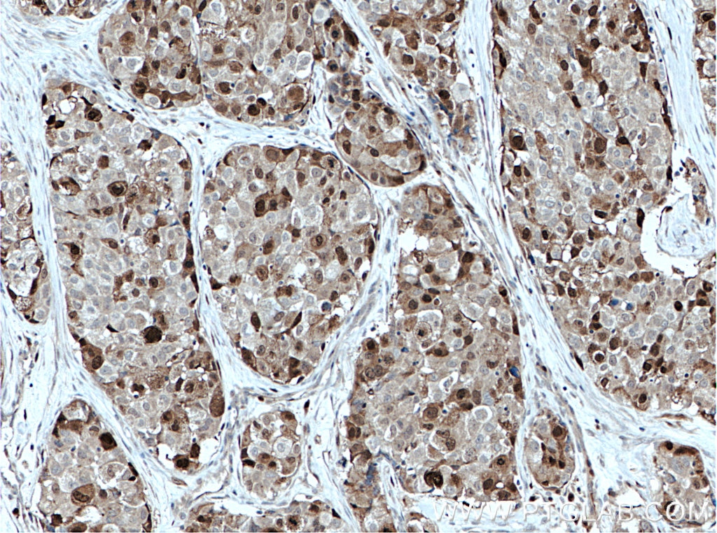 Immunohistochemistry (IHC) staining of human lung cancer tissue using PBK Polyclonal antibody (16110-1-AP)